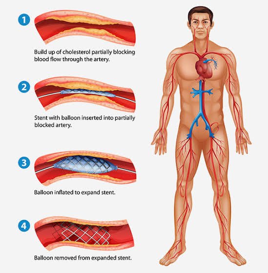coronary interventions