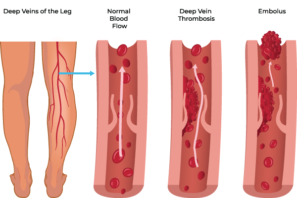 deep venous