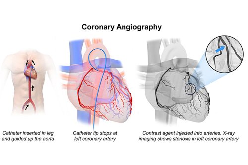 Coronary Angiogram know about coronary angiography