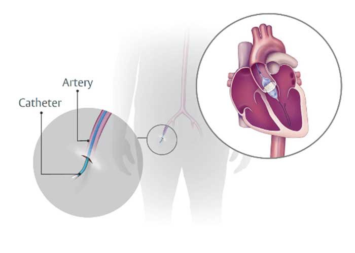 TAVR